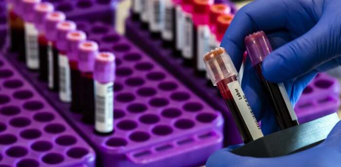 Τα κρούσματα κορωνοϊού στους δήμους του νομού Λάρισας – Η εικόνα στην Ελασσόνα